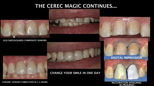 The magic of CEREC restorations...